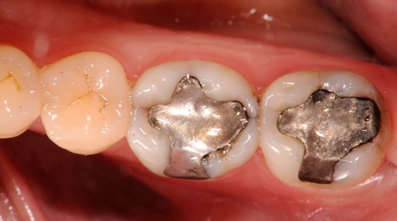 Le otturazioni grigie dei denti fanno male?